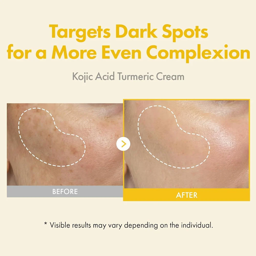 TOSOWOONG - Kojic Acid Turmeric Cream for Dark Spots & Hyperpigmentation - 50ml